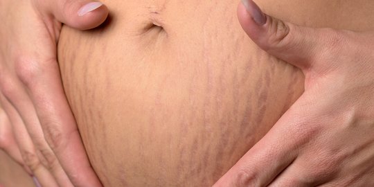 Menghilangkan Stretch Mark Pasca Melahirkan, Lakukan 5 Cara Ini