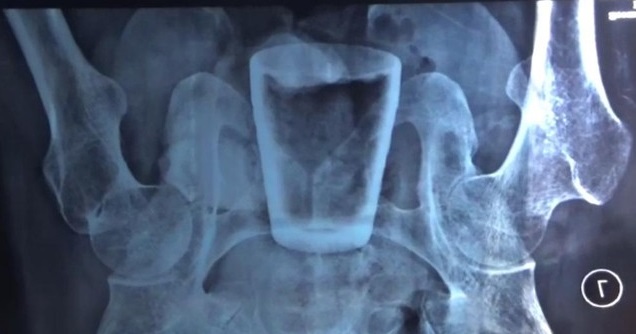 Hasil rotgen Nur Lasidi menunjukkan ada gelas kaca dalam perutnya (Foto / Metro TV)
