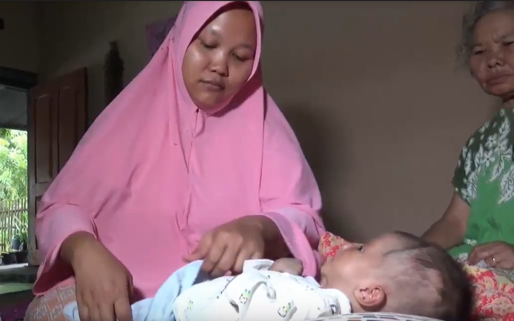 Butuh Uluran Tangan, Bayi Penderita Hidrosefalus di Ngawi Alami Gizi Buruk