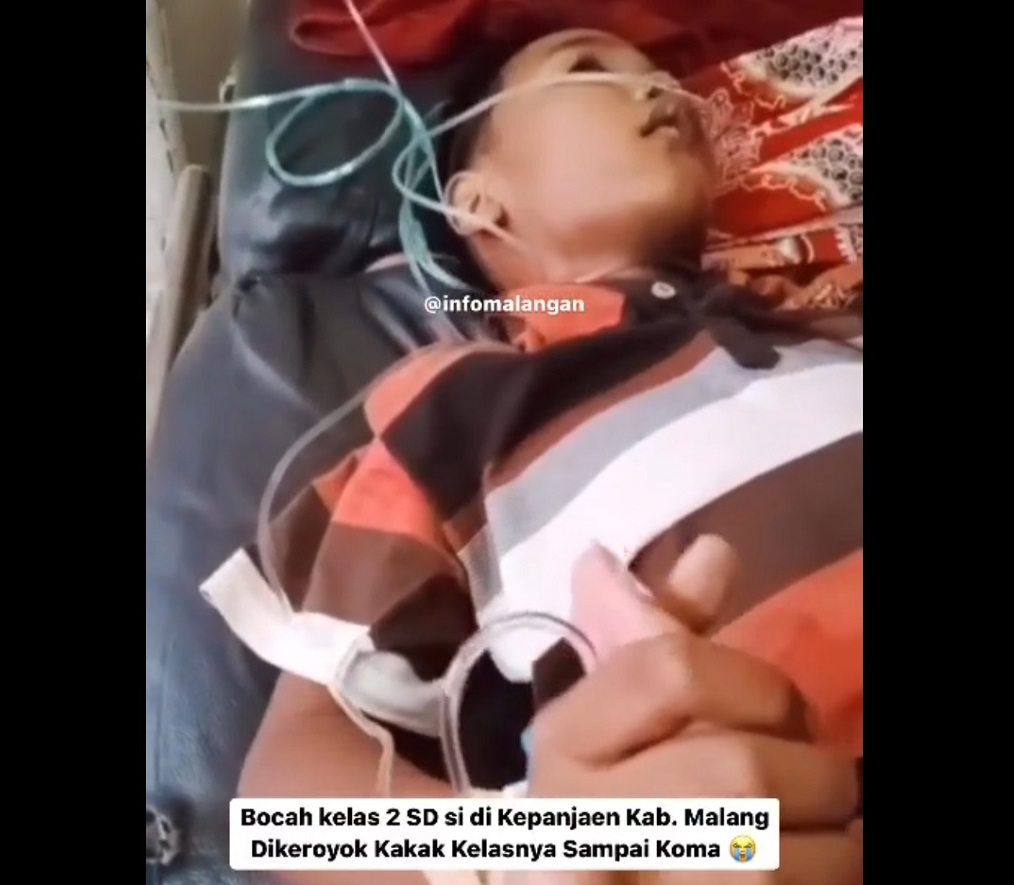 Pendarahan Otak, Bocah Korban Perundungan di Malang Jalani CT Scan Lanjutan